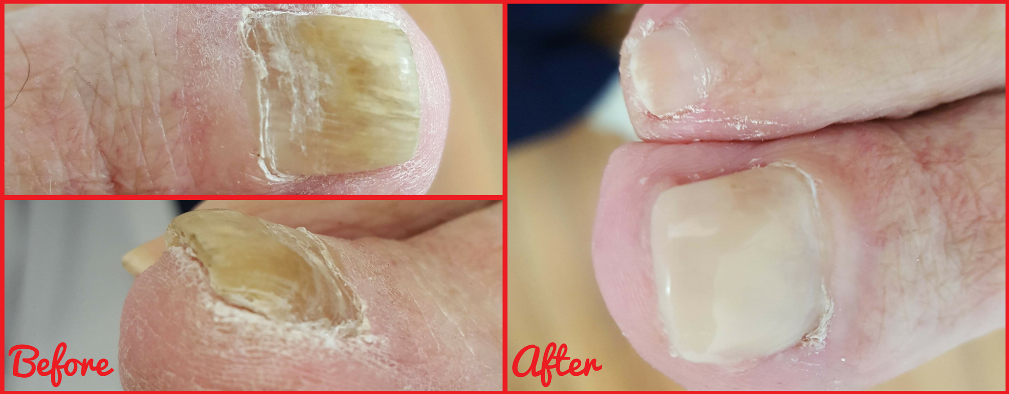 A Day in the Life of a Podiatrist: Gel Nail Reconstruction